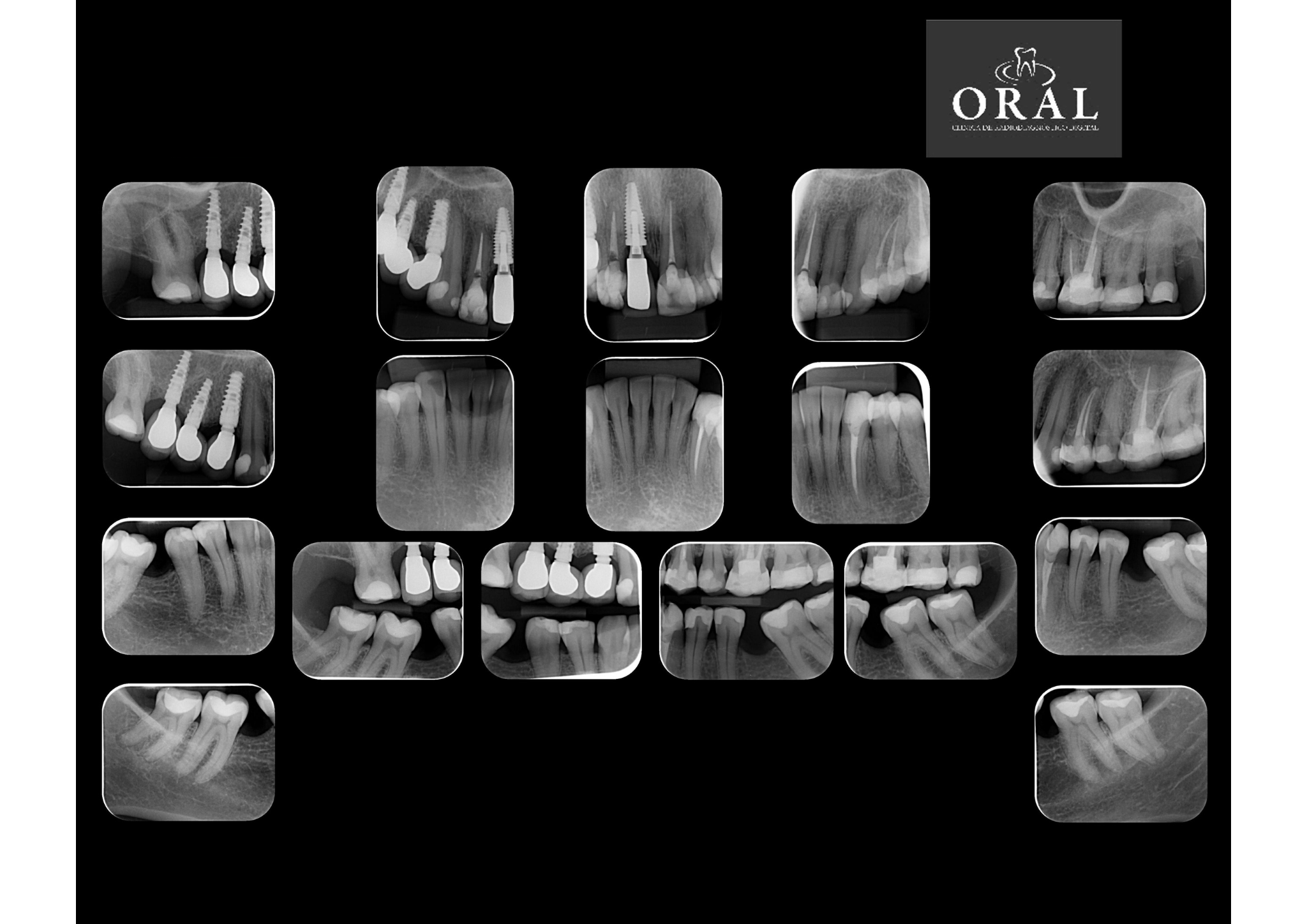 Radiografias Periapicais